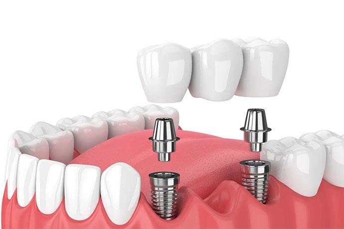 İmplant Diş Nedir, Kimlere Yapılır, Süreç ve Bakım Rehberi